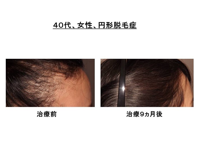 円形脱毛症　病院""